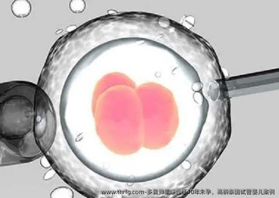 多囊卵巢综合征10年未孕，高龄泰国试管婴儿案例