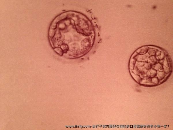 治疗子宫内膜异位症的进口诺雷德针剂多少钱一支？