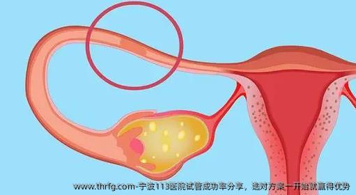 宁波113医院试管成功率分享，选对方案一开始就赢得优势